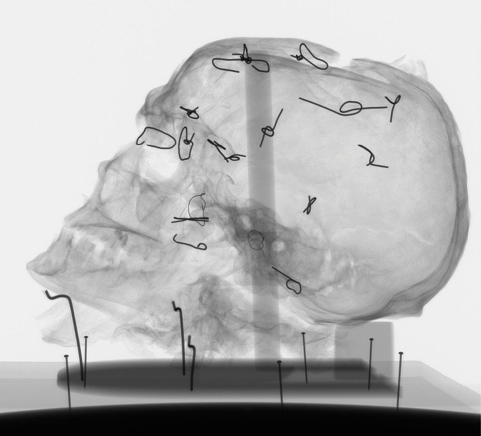 LEFT Recent CT scanning of Worsley Man’s head shed new light on his injuries as well as illuminating the rather rudimentary conservation he had undergone in the past.