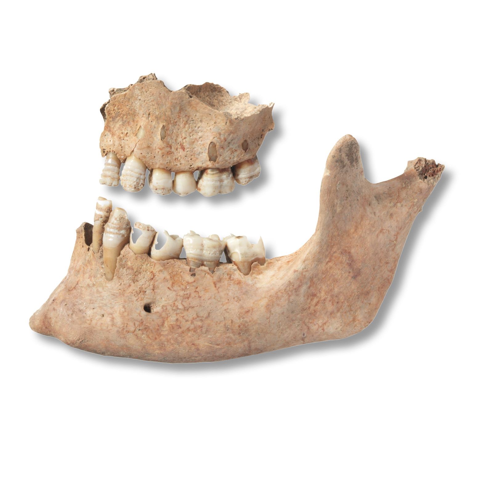 above This 18- to 25-year-old female died in the first half of the 13th century, and her teeth show marked striations. Known as dental hypoplasia, the condition is typically associated with deprivation, perhaps brought on by famine, during childhood.