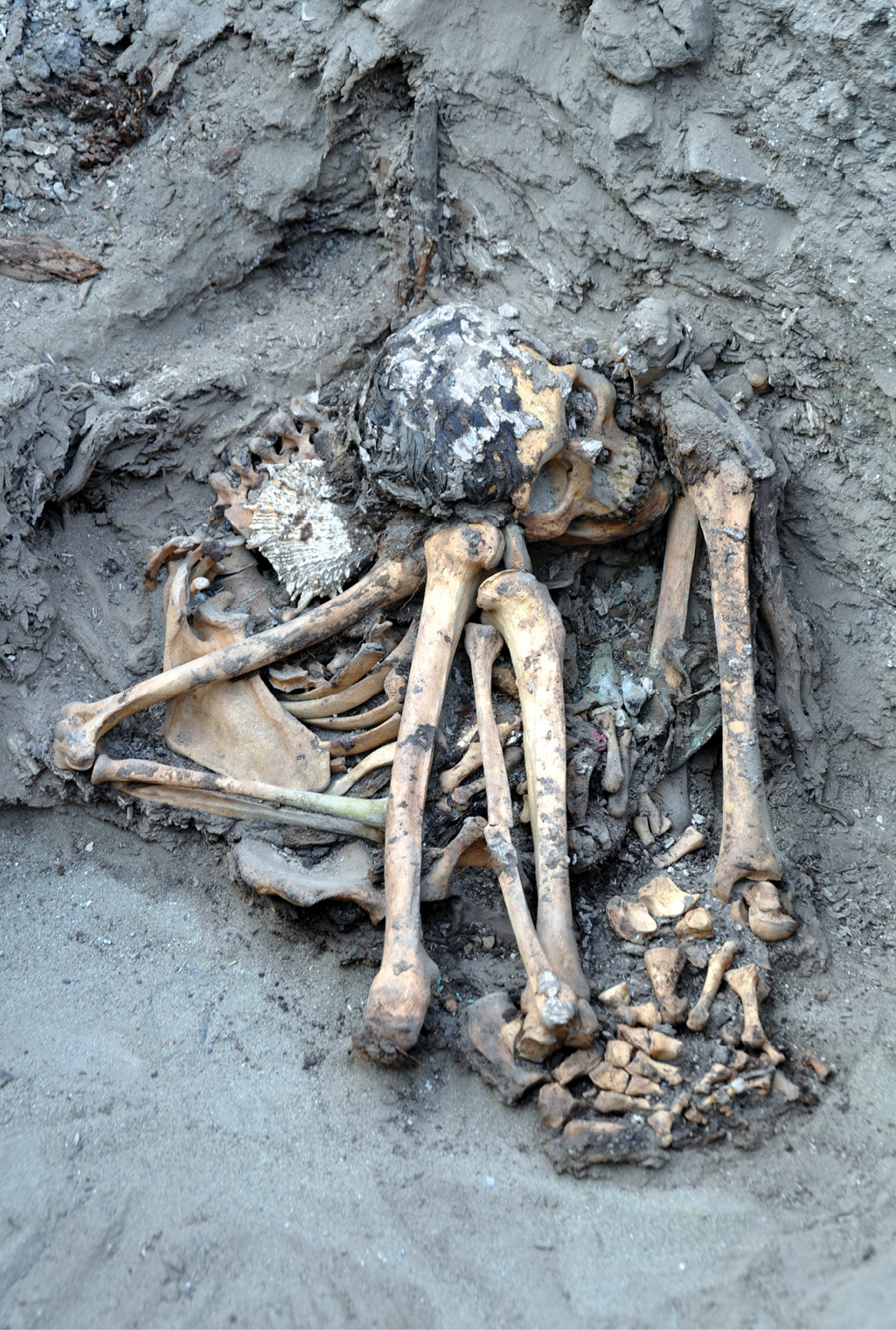 left This burial from the cemetery in front of the Pachacamac Temple is of an Ychsma adult male, who was revealed to have died of osteomyelitis that is, inflammation of the bone or marrow by Lawrence S Owens, Chief Anthropologist with the Ychsma Project. The deceased also had a benign cancer. A series of Spondylus shells on the shoulders and in the hands are a possible indicator of wealth.