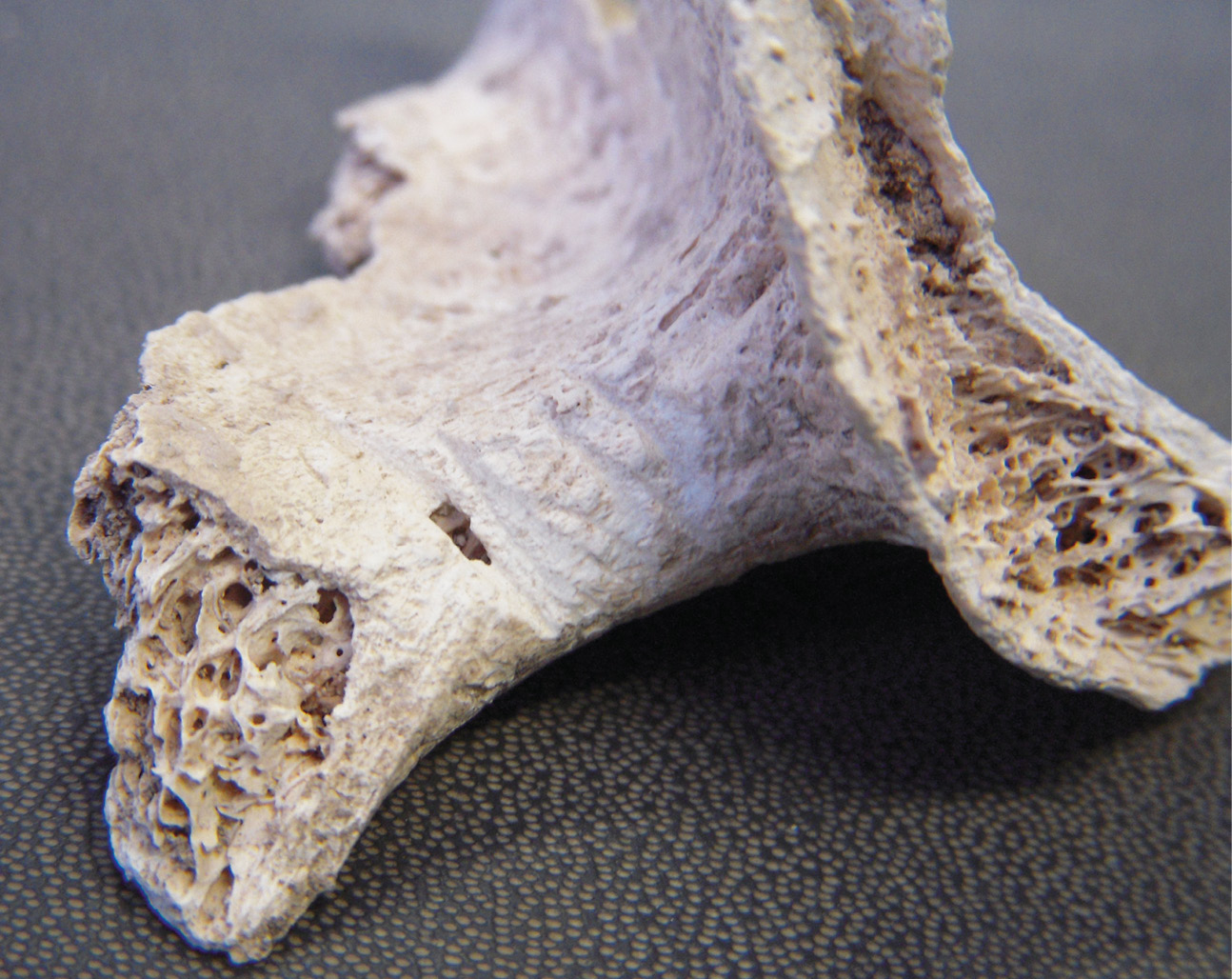 Top On the right shoulder blade of the adolescent in burial F4, multiple cut- or chop-marks are visible (in the centre of the photograph). They provided the first clue that there were some unusual post-mortem processes underway. INSET This deep cut-mark was visible on the right kneecap of F4.