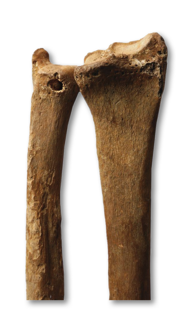 BELOW Drilling has also been identified on a Bronze Age specimen from Over, Cambridgeshire, where an articulated skeleton was found with a perforated right ulna or