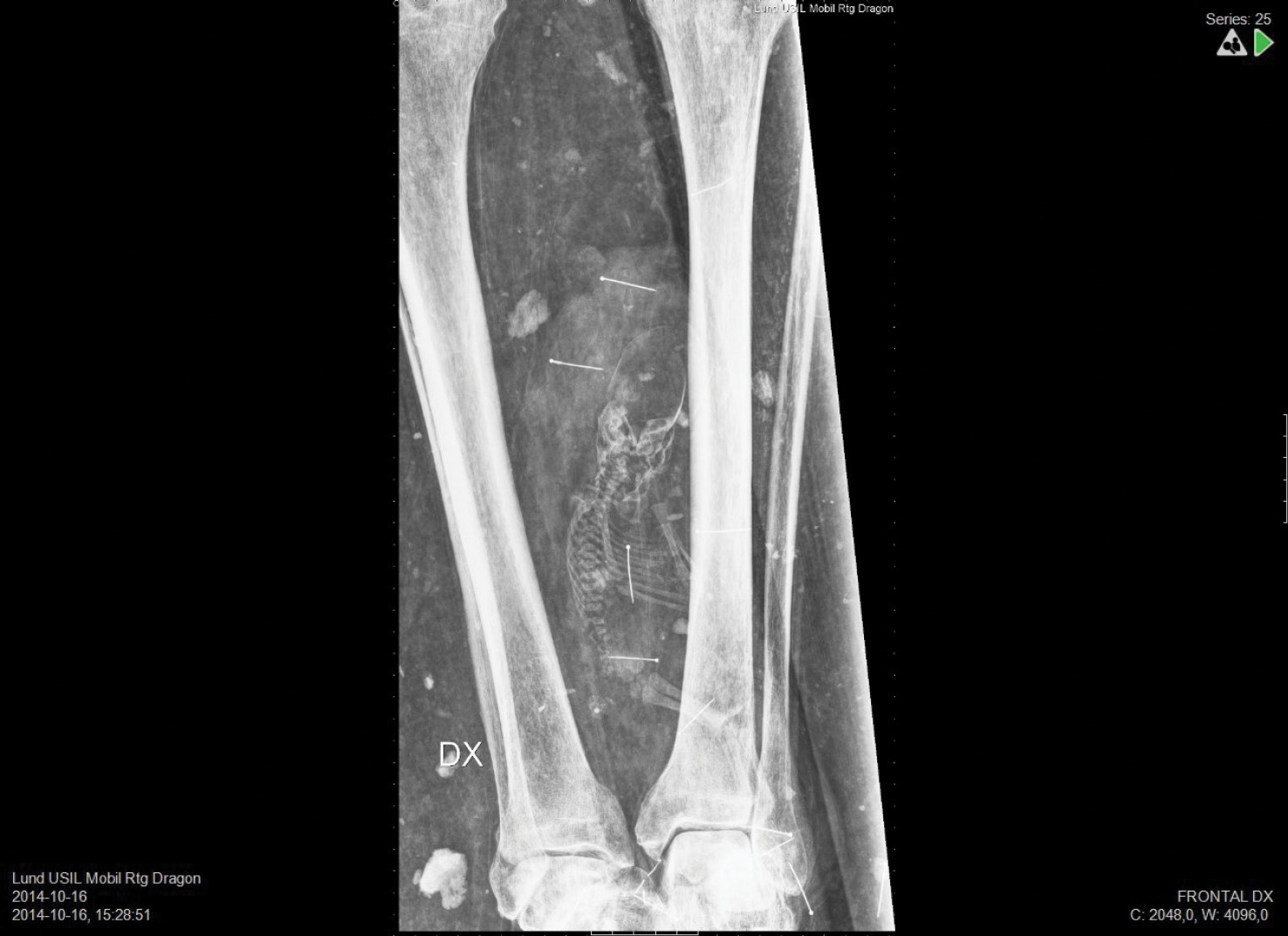 ABOVE One unexpected discovery when the remains of Peder Winstrup were studied in 2013 came about when his coffin was X-rayed. This revealed that he had a companion a premature baby who had been concealed under the bishop’s shin.