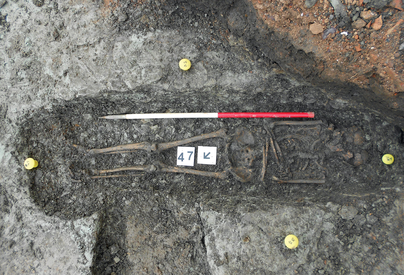 above The remains of these inhabitants of Roman Leicester give vivid insights into their lives. One (Bottom) was a mature woman (aged 46+), who had slight scoliosis of the spine and stood 5ft 4in (162.6cm) tall. She also suffered from sinusitis, and had a degenerative disc disease and osteoarthritis in her spine, shoulders, right wrist, and hand. The other (top), a young man (aged 18-25), was 5ft 10in (177.8cm) tall, above average height for the cemetery population, but had tuberculosis as well as an infection in his left forearm which had caused the bone to swell.