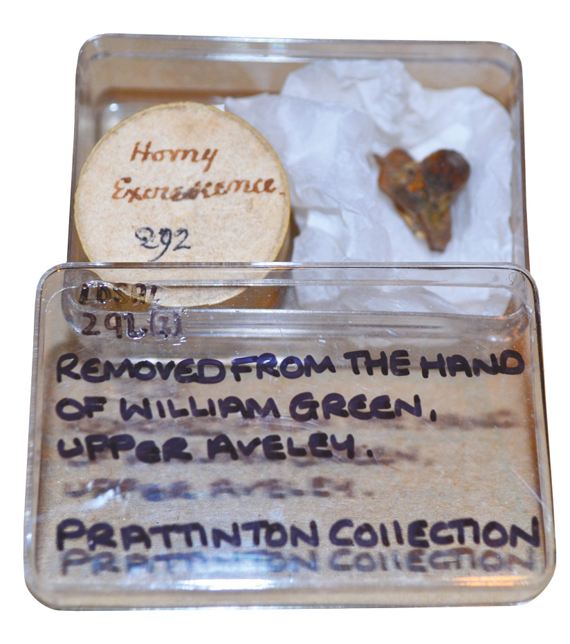 LEFT One of the more striking ‘objects’ held by the Society of Antiquaries: a wart from a human hand, donated by a Fellow in the Victorian period.