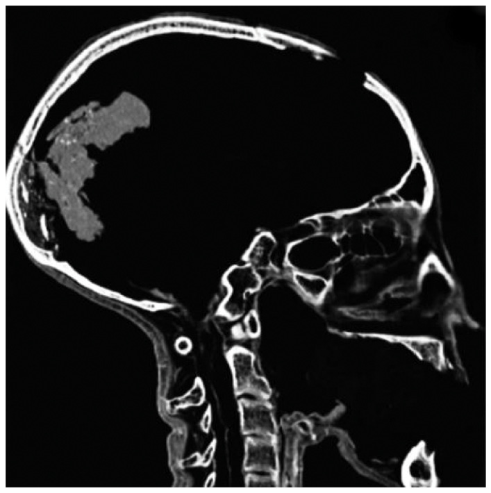 INSET CT image of the head of the Younger Lady found in KV 35, identified as the mother of Tutankhamen. From the defect identified on the left-hand side of the face, it appears that she died of injuries resulting from a violent shock to the face. The researchers suggest the strong kick of a horse. RIGHT CT image of Pharaoh Seti I. Embalming materials, such as linen and resin, were placed behind the orbits, within the nasal cavity, and under the skin of the neck to render a life-like appearance. Within the skull emptied of the brain, packing was inserted, visible on this CT scan. Its density is different from that of bones or human soft tissue.