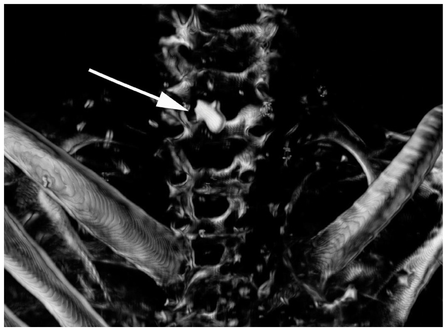 left (top) Three-dimensional CT scanning of the upper torso of Ramesses III indicating the position of the ‘protective’ amulet (upside down) in front of the cut wound that was preserved by the embalming process. LEFT (below) While the long arrows indicate linen and embalming materials packed under the skin, the arrowhead shows the rather thick skin of the mummy, likely due to resin coating.